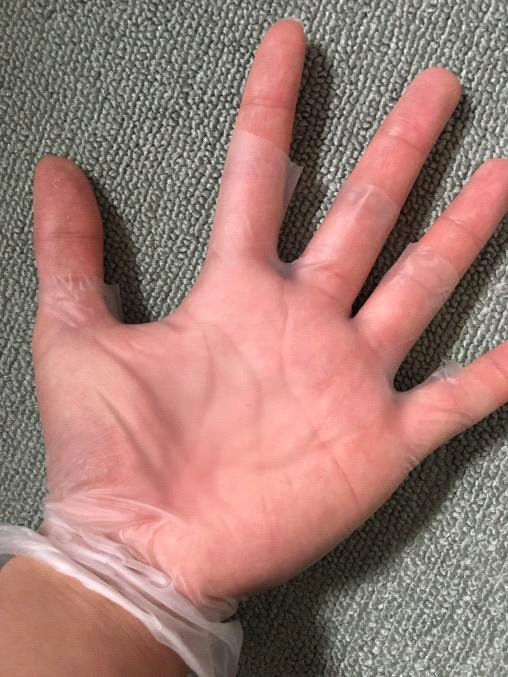 プラスチック製の透明な手袋をした左手の写真。指先だけ手袋を切っている。toraの手掌多汗症対策として、スマートフォンのゲームをプレイする際に使用。